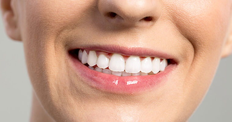 Nevidni zobni aparat je sodobna pot do lepšega nasmeha