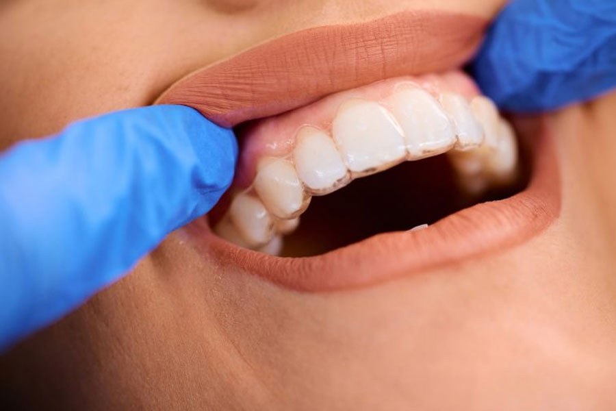 Nevidni zobni aparat